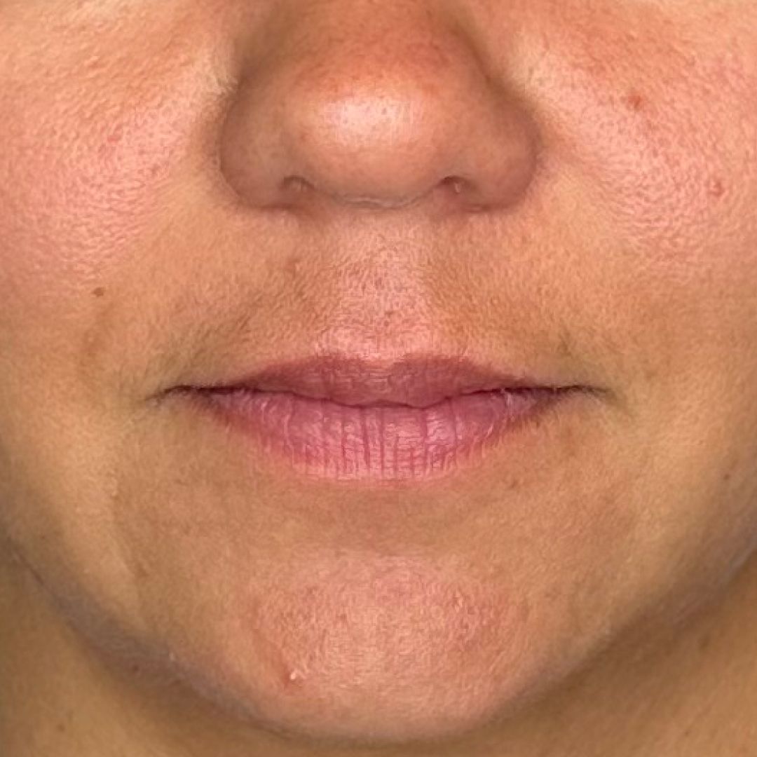 Bild på läppar före behandling