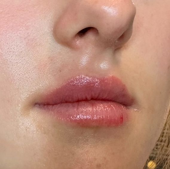 Bild på läppar efter behandling