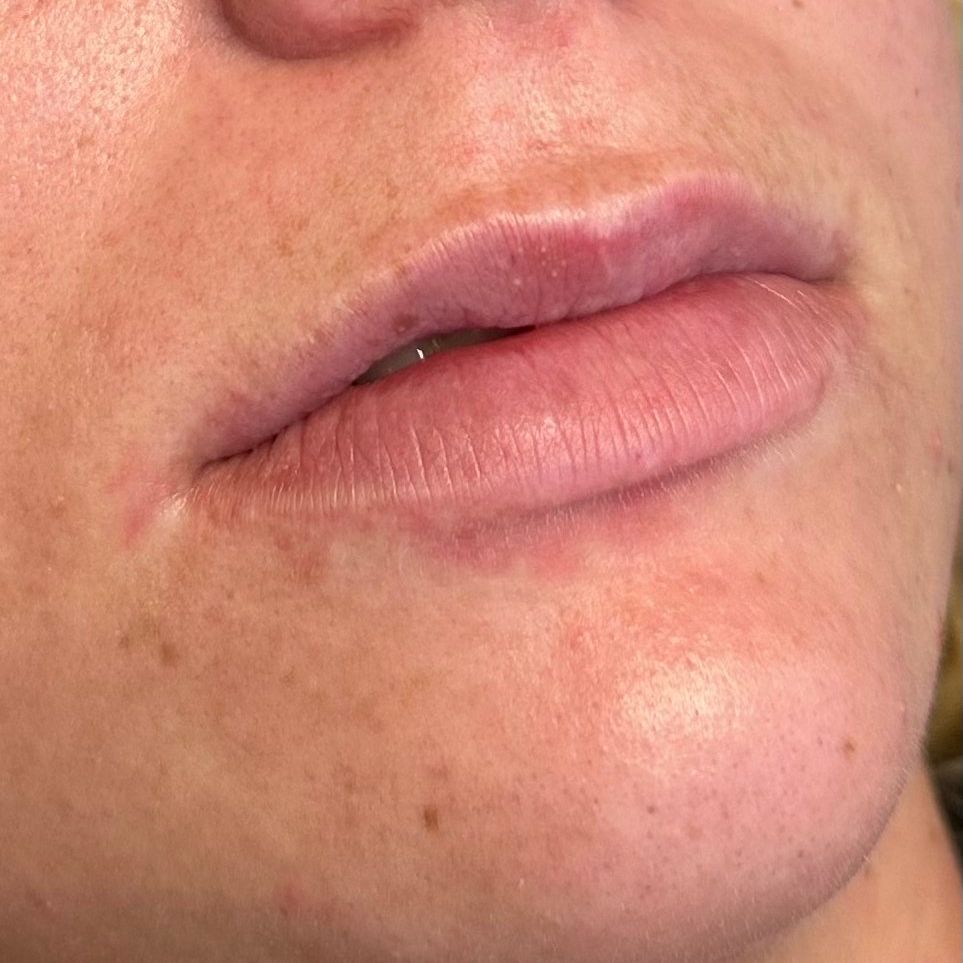 Bild på läppar före behandling