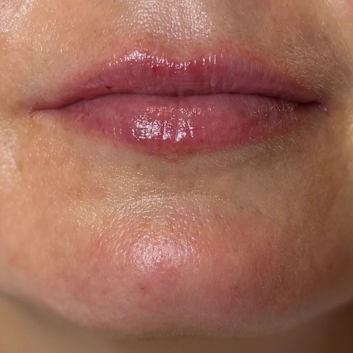 Bild på läppar efter behandling
