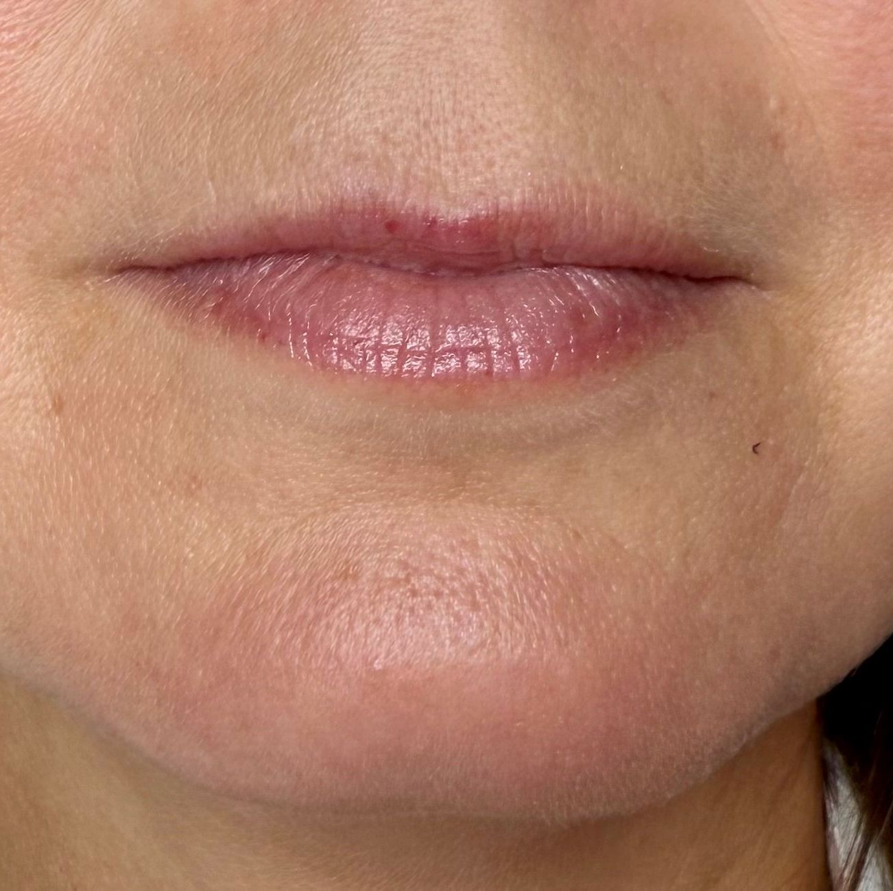 Bild på läppar före behandling
