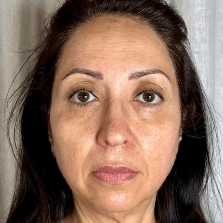 Bild efter behandling