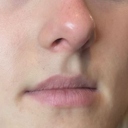 Bild på läppar före behandling