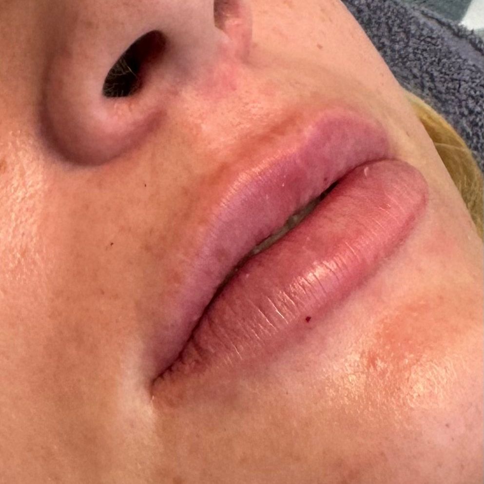 Bild på läppar efter behandling