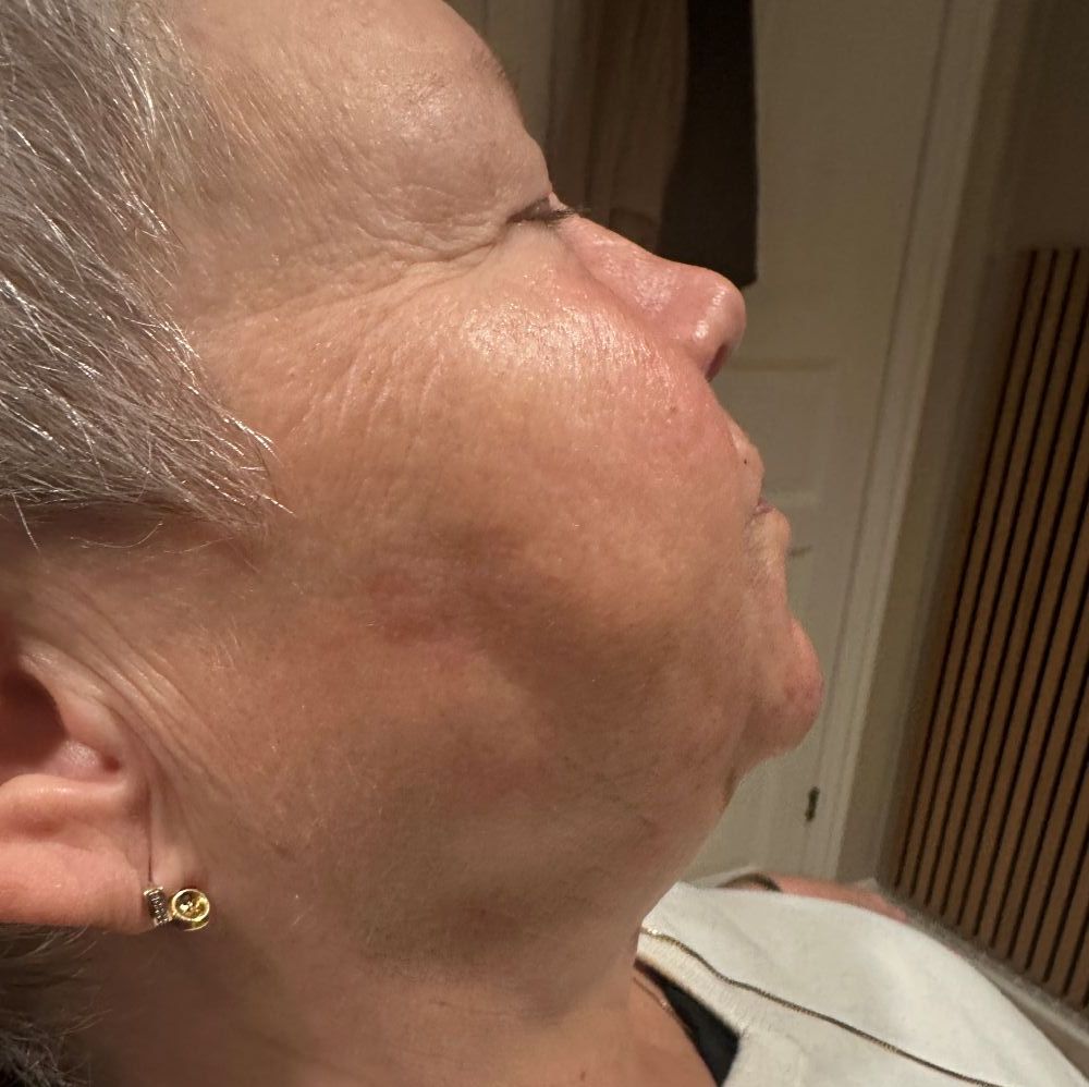 Bild efter behandling