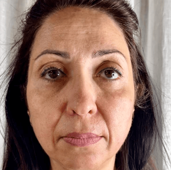 Bild före behandling