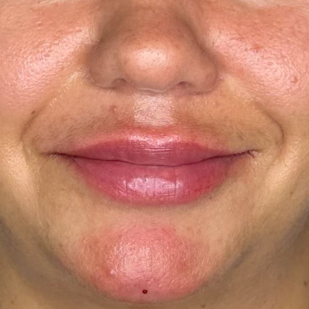 Bild på läppar efter behandling